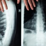 Top Non-Surgical Approaches to Managing Spinal Arthritis Pain